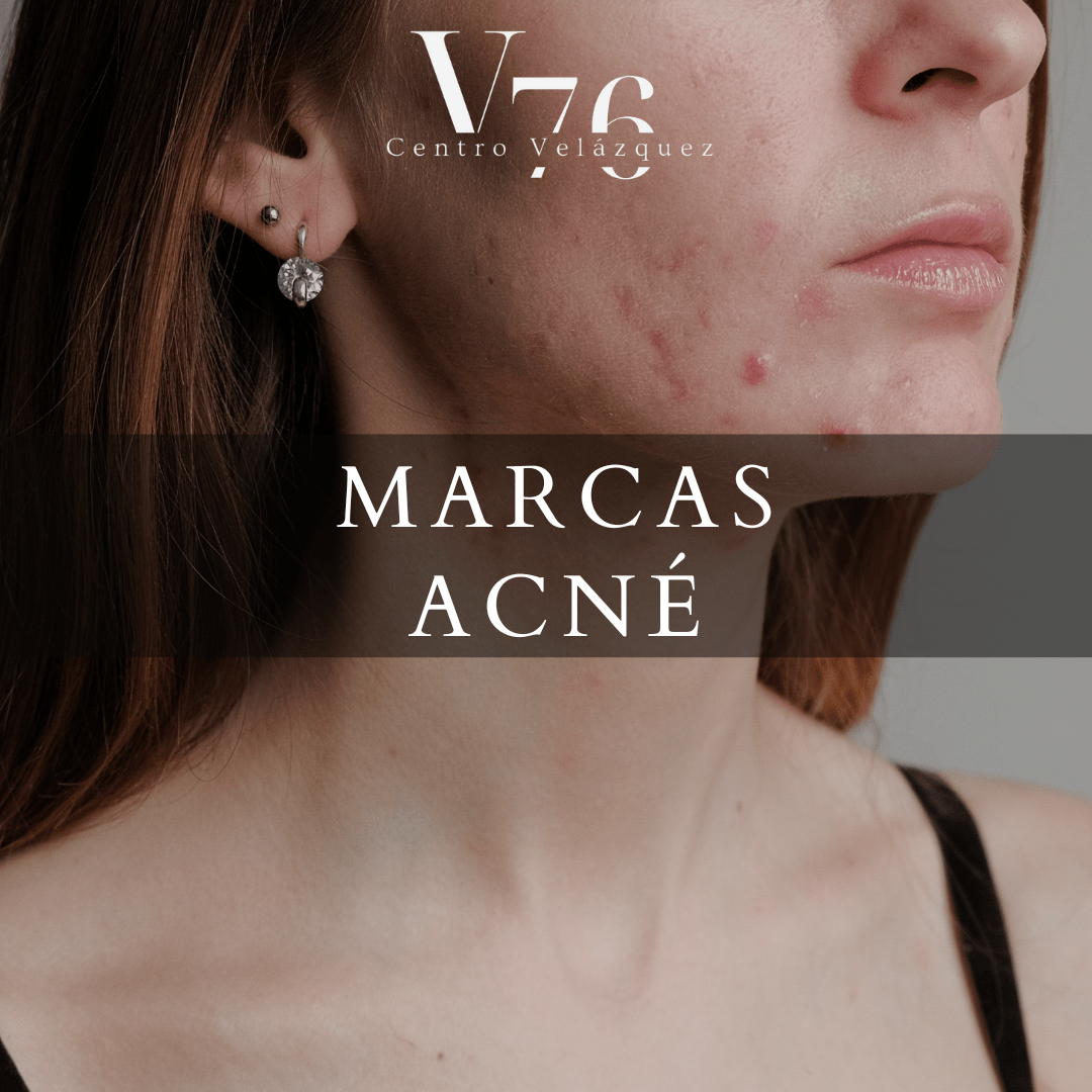 MARCAS ACNE