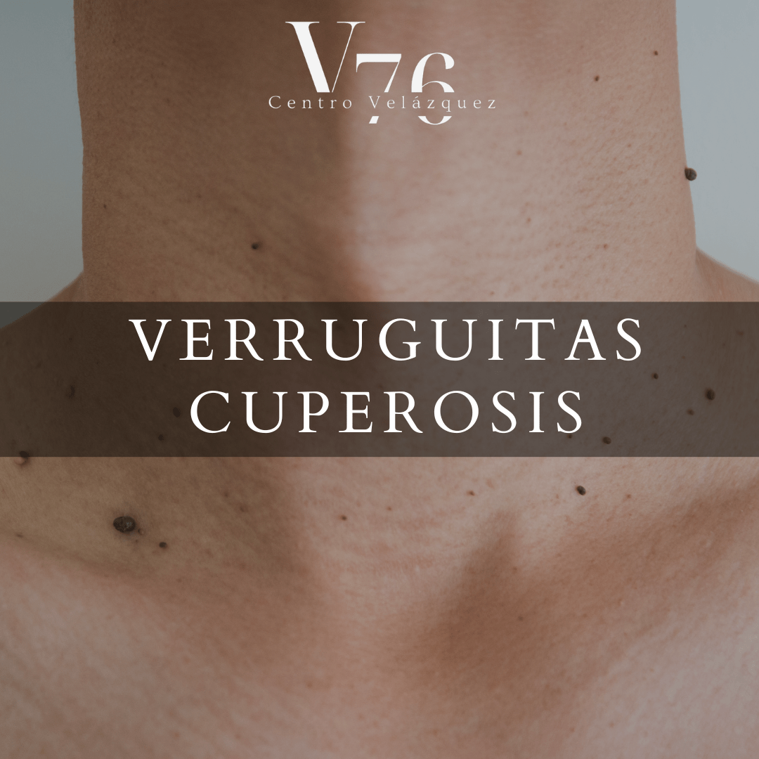 CUPEROSIS, VERRUGUITAS