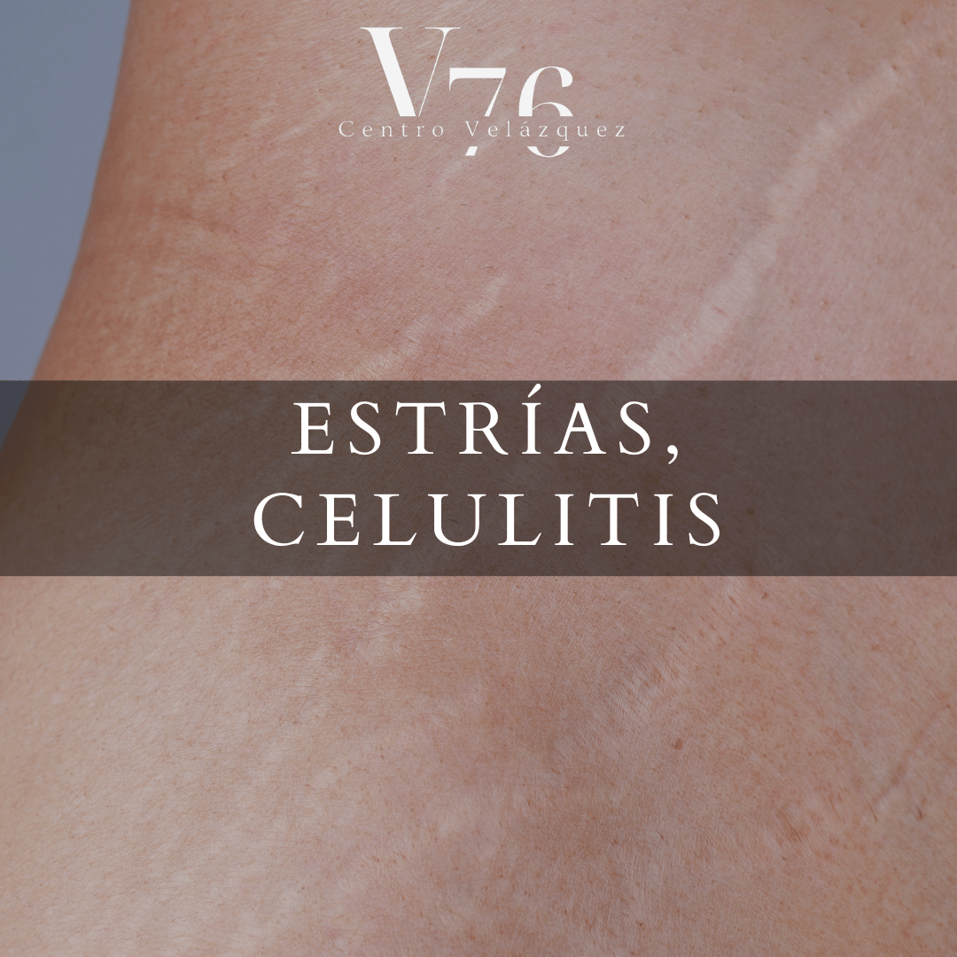 CELULITIS, PIEL DE NARANJA, ESTRIAS