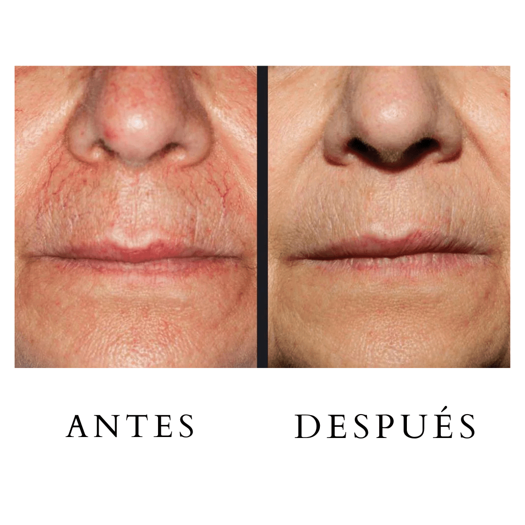 Depilaci Nl Efectos Secundarios Depilacion Laser Depilación